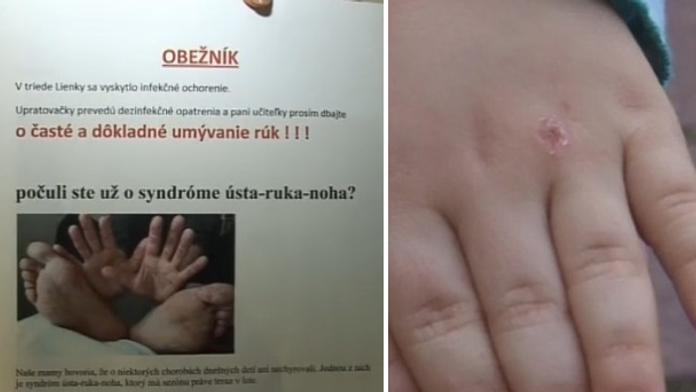 Ničí jim ruce! Na Slovensku zasáhla děti podivná choroba