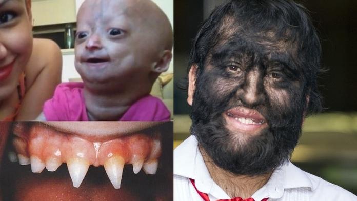 Když se lidé mění ve ZRŮDY! Podívejte se na nejpodivnější nemoci světa!