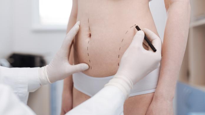 Sen o dokonalých křivkách: Vše o liposukci a tvarování těla