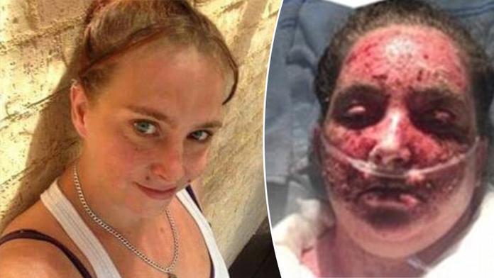 Sára si popálila 98 procent těla. Kvůli ekzému se koupala v bělidle