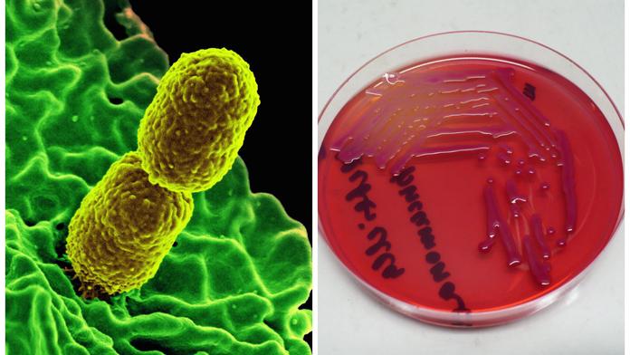 Super rezistentní bakterie zabíjela, nepomohlo 26 druhů antibiotik