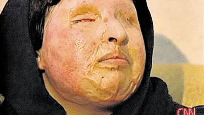 Muž polil spící manželku kyselinou! Rodila dcery, chtěl syna