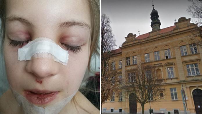 Pád dívky (8) ve škole vyšetřuje policie! Podle matky mohla zemřít
