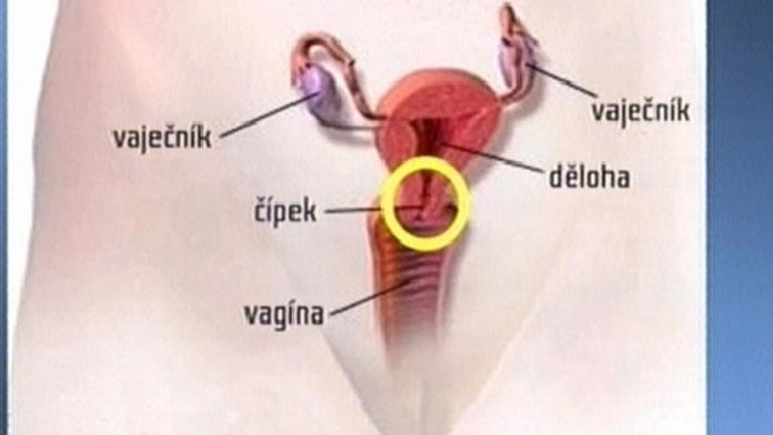 Nová vakcína proti rakovině děložního čípku