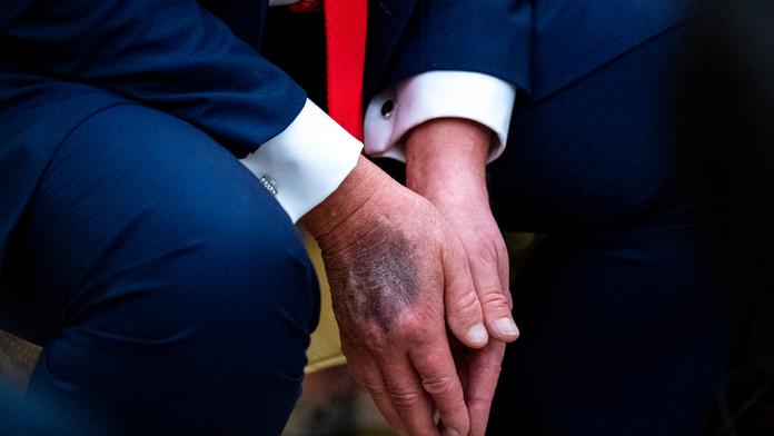 Záběry Trumpa vyvolaly divoké spekulace o jeho zdraví. Bílý dům má bizarní vysvětlení