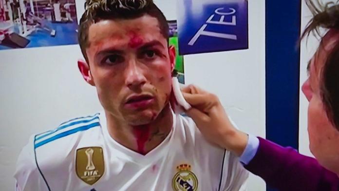 Ronaldovo krvavé zranění zblízka: Tohle dělal lékař v kabině! VIDEO