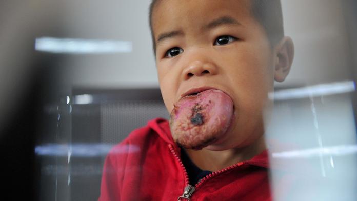 Má třikrát větší jazyk! Malý chlapec (4) nemůže ani jíst