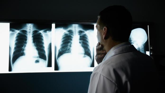 Rakovinu plic lidé odhalují pozdě. Lékaři upozorňují na tři nenápadné, ale zásadní příznaky
