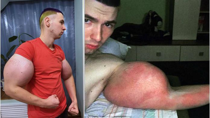 Tenhle mladík má přes bicák 65 cm. Ruce mu ale možná amputují!