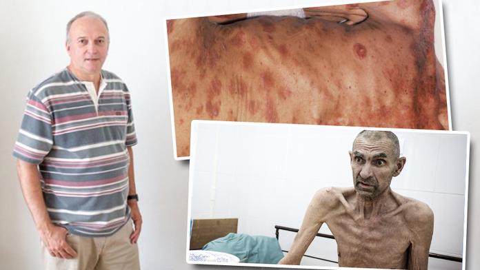 Pravá tvář AIDS: Muž promluvil o utrpení umírajících! SVĚDECTVÍ