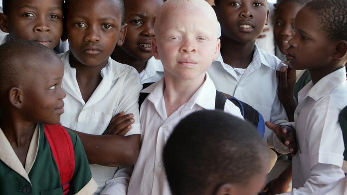 V Malawi vraždí albíny. Lidé věří, že má jejich tělo magickou moc