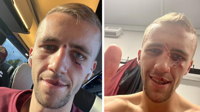 Nikdy se nevzdám, uklidnil fanoušky Tomáš Souček a ukázal sešitý obličej