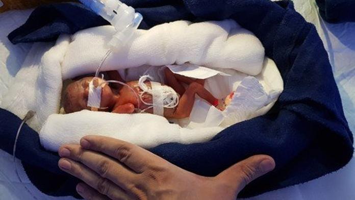 Novorozenec vážil jen 400 gramů, ale přežil! Slova lékaře dojala svět
