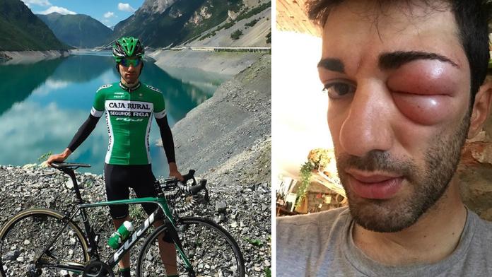 Cyklista se po štípnutí změnil v monstrum! Překvapila ho alergie