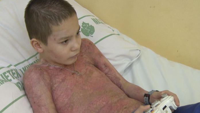 ZÁZRAK! Sam měl popáleniny na 85 procentech těla, teď jde domů