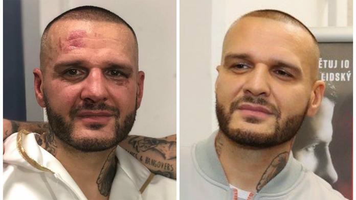 Marpo Rytmusovi upravil fasádu! Fotky rappera před a po zápase