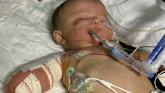 Dívenka trpí nejhorší meningitidou za 25 let! Amputovali jí nohy i ruce