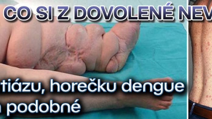 Co si z dovolené nevozit: elefantiázu, horečku dengue ani jim podobné