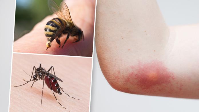 Sezóna štípanců začíná! Poradíme vám, jak se proti nim bránit