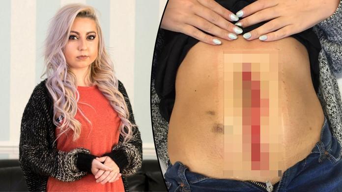 Hrůzný případ: Dívce praskla jizva, viděla si do žaludku! FOTKY