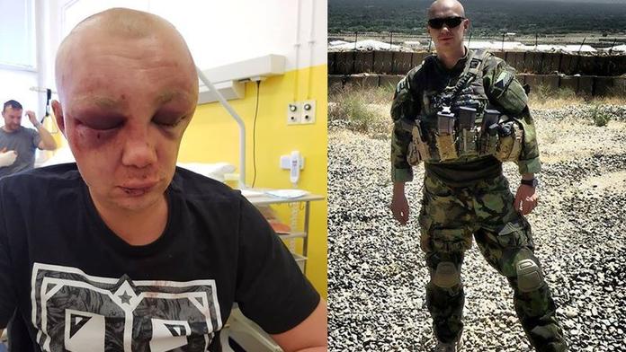 Mladého vojáka zkopali v Teplicích do bezvědomí. Praskla mu lebka!