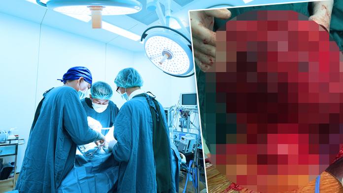 Ženě vyoperovali obří nádor. Mohlo ji zabít ťuknutí do břicha