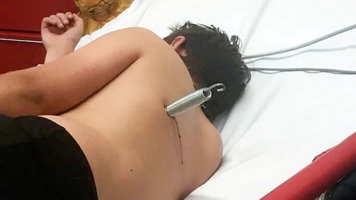 Hra na trampolíně se změnila v horor! Chlapec skončil s pružinou v zádech