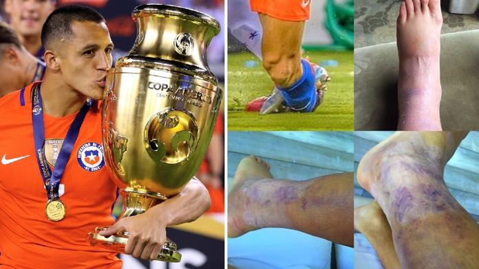 Tohle je můj kotník! Superstar z Arsenalu vyděsila fanoušky