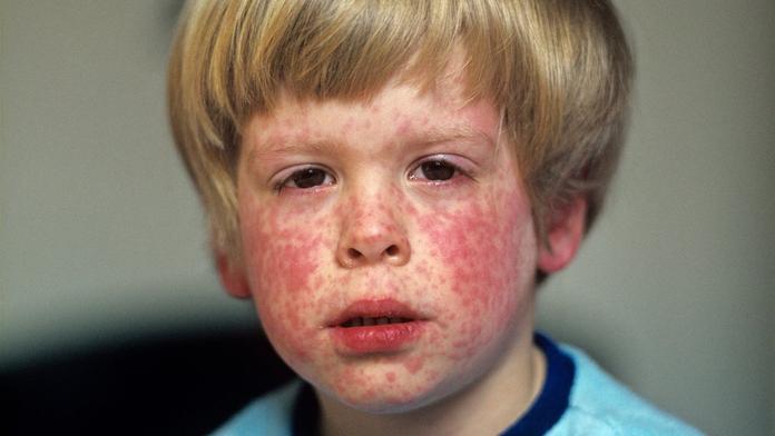 Epidemie spalniček má jednoho viníka. Stopy vedou do Ruska