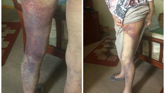 Lupič přepadl babičku (92) kvůli stovce! Utrpěla děsivá zranění