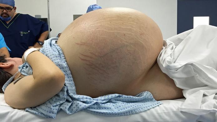 Žena nejedla, břicho jí ale rostlo! Lékaři vyoperovali 33kilový nádor