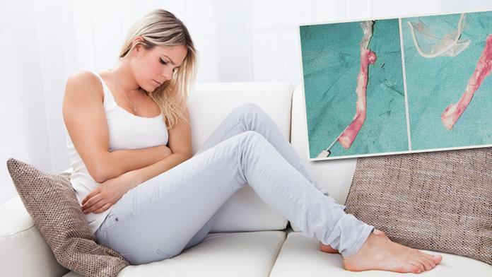 Žena šla k lékaři s bolestí břicha. Co jí našli ve slepáku, je šokovalo