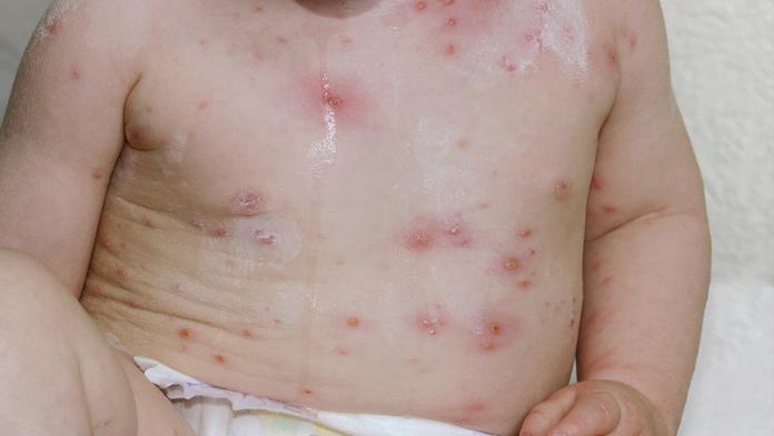 V Evropě jsou opičí neštovice! Vakcína není, lékaři děsí pandemií