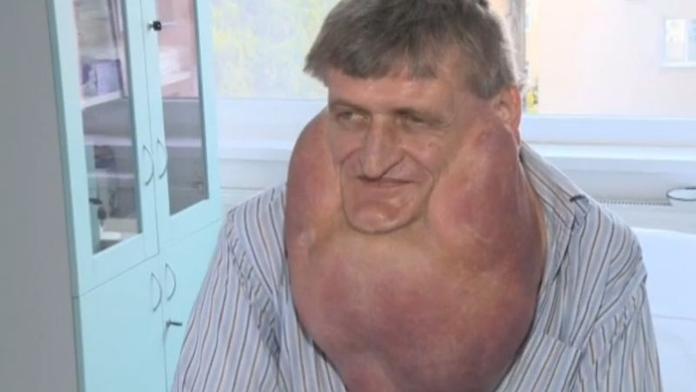 Krutý osud: Pana Štefana trápil OBROVITÝ NÁDOR!