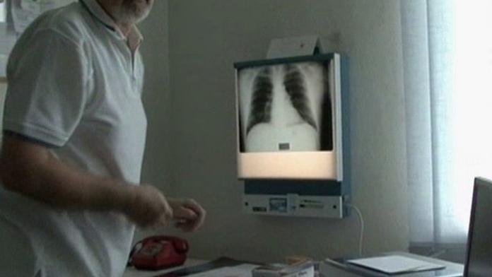 Ve vsi chodil muž nakažený tuberkulózou