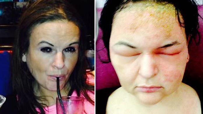 Spálená kůže, hlava jako míč! Tinu (41) skoro zabila barva na vlasy