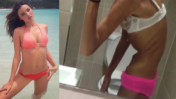 Dívka skoro zemřela hlady! Chtěla vypadat jako slavný Andílek