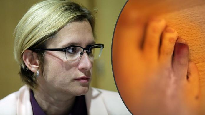 Šlechtová přiznala vážné zdravotní problémy. Bojí se, že přijde o prst!