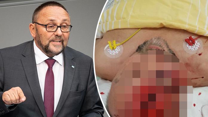 Poslance AfD v Brémách brutálně napadli. Je vážně zraněný