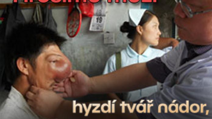 "Hrošímu muži" hyzdí tvář nádor, pomoci by mu měla operace