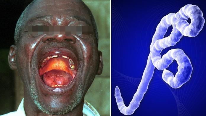 Strach z masivní nákazy: SMRTÍCÍ EBOLA mutuje do nové podoby