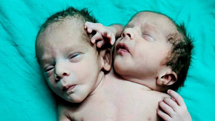 Matka v Indii si myslela, že čeká dvojčata. Porodila dítě se dvěma hlavami