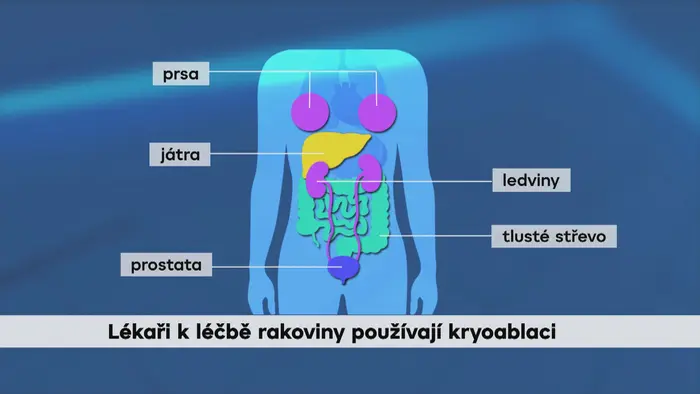 Rakovina grafika