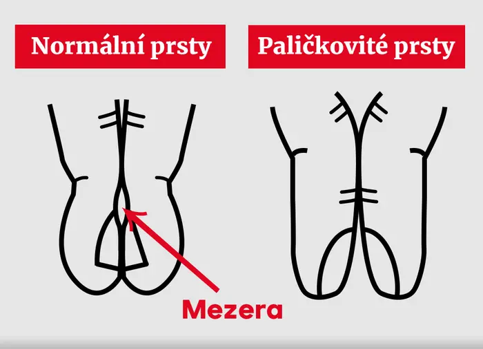 Rozdíl mezi normálními a paličkovitými prsty