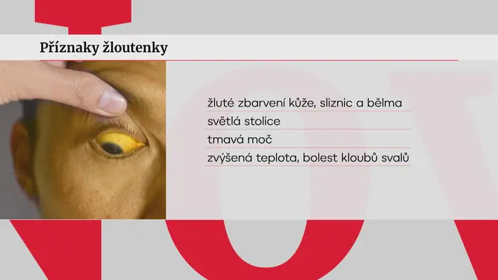 Příznaky žloutenky