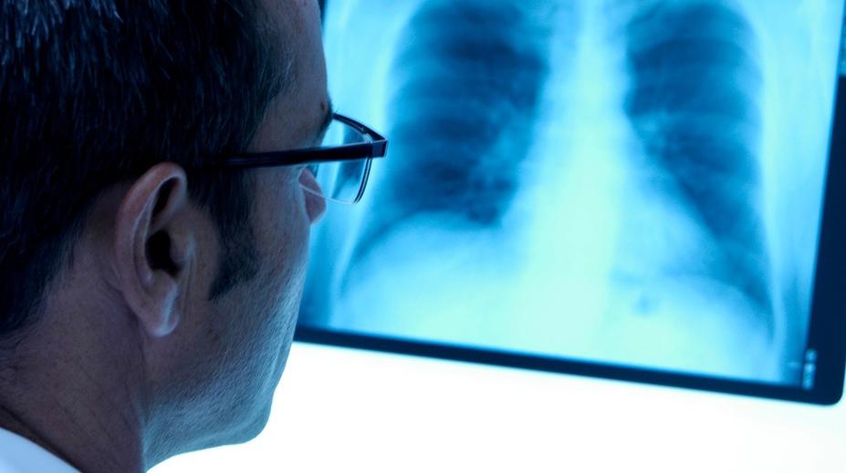 Plicní embolie v Česku ročně potká přibližně 10 tisíc lidí. Postihnout může i mladé