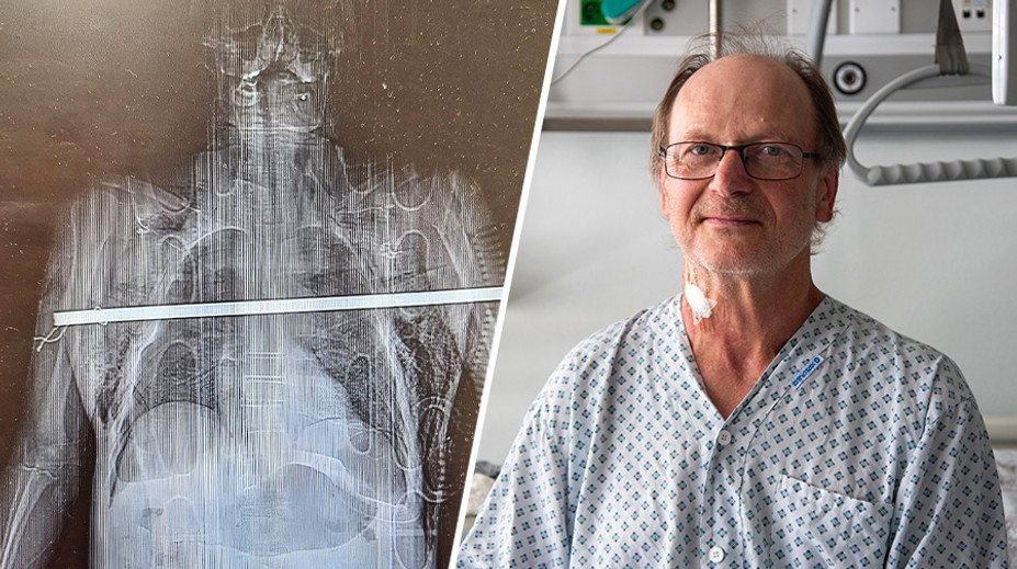 Trhal třešně, spadl a obě plíce mu propíchla tyč. Lékaři mu otevřeli hrudník