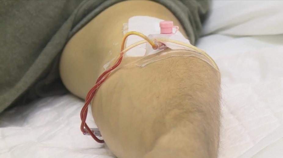 Ústecký kraj bojuje se žloutenkou. Objevila se ve školkách, prozradil lékař