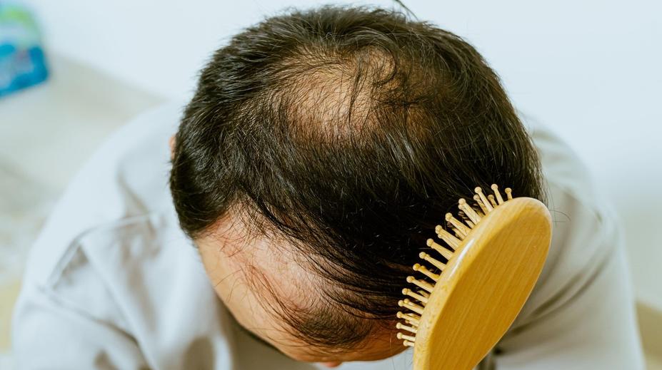 SÚKL varuje před vážnými vedlejšími účinky léku na alopecii. Lidé mohou i zemřít