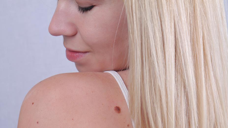 Nebezpečné znaménko: Poznáte rozdíl mezi pihou a pigmentovou skvrnou?